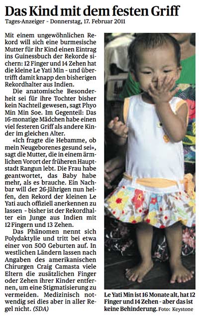 12 Finger und 14 Zehen hat die kleine Le Yati Min (…). Die anatomische Besonderheit sei für ihre Tochter bisher kein Nachteil gewesen, sagt Phyo Min Min Soe. Im Gegenteil: Das 16-monatige Mädchen habe einen viel festeren Griff als andere Kinder im gleichen Alter. (…) Das Phänomen nennt sich Polydaktylie und tritt bei etwa einer von 500 Geburten auf. In westlichen Ländern lassen nach Angaben des amerikanischen Chirurgen Craig Camasta viele Eltern die zusätzlichen Finger oder Zehen ihrer Kinder entfernen, um eine Stigmatisierung zu vermeiden. Medizinisch notwendig sei dies aber in aller Regel nicht.